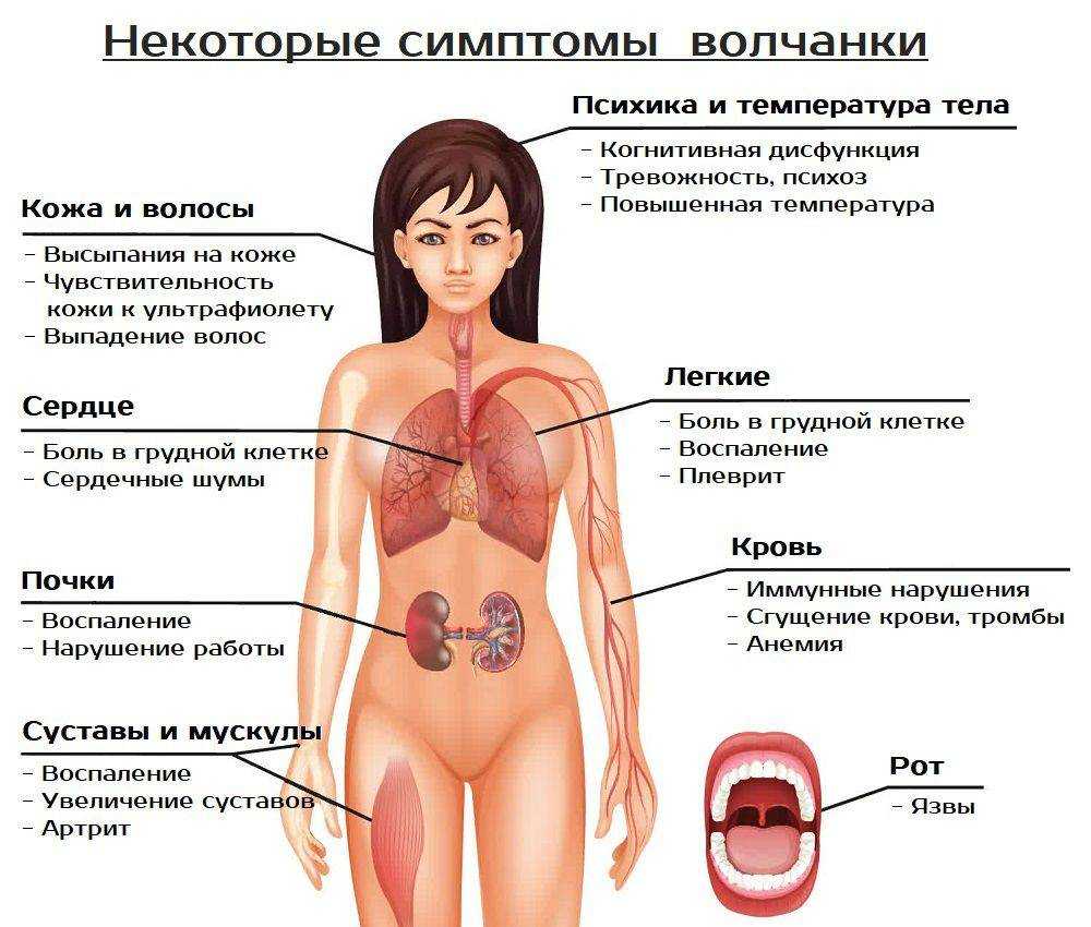 Красная волчанка симптомы анализ крови показатели лечение фото у женщин