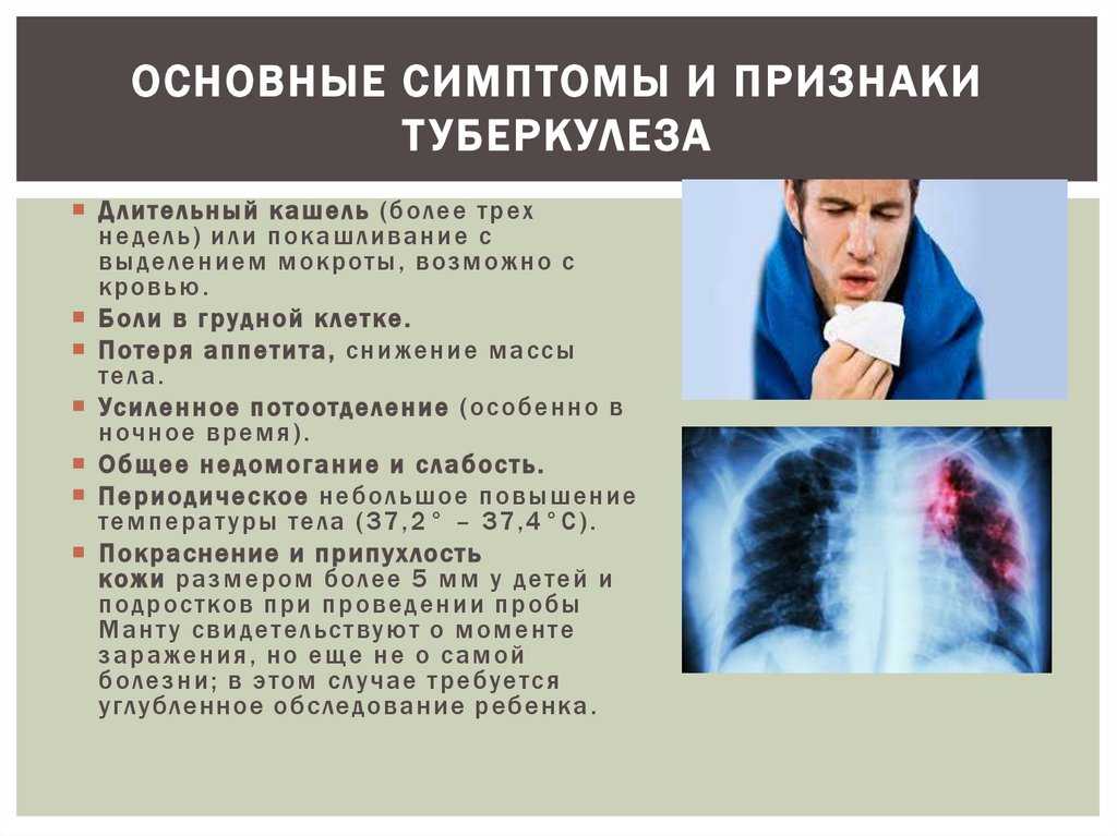 Туберкулез конспект. Проявление туберкулеза. Общие симптомы туберкулеза.