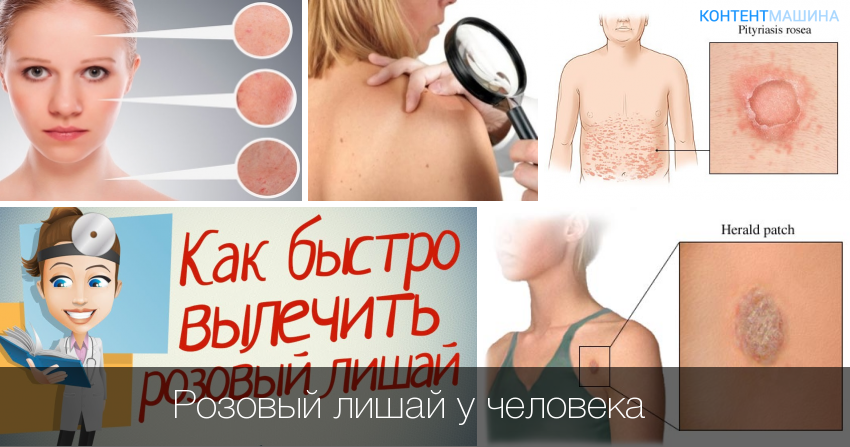 Стригущий лишай у кошек фото признаки и лечение в домашних условиях (мокнущий и розовый лишай)