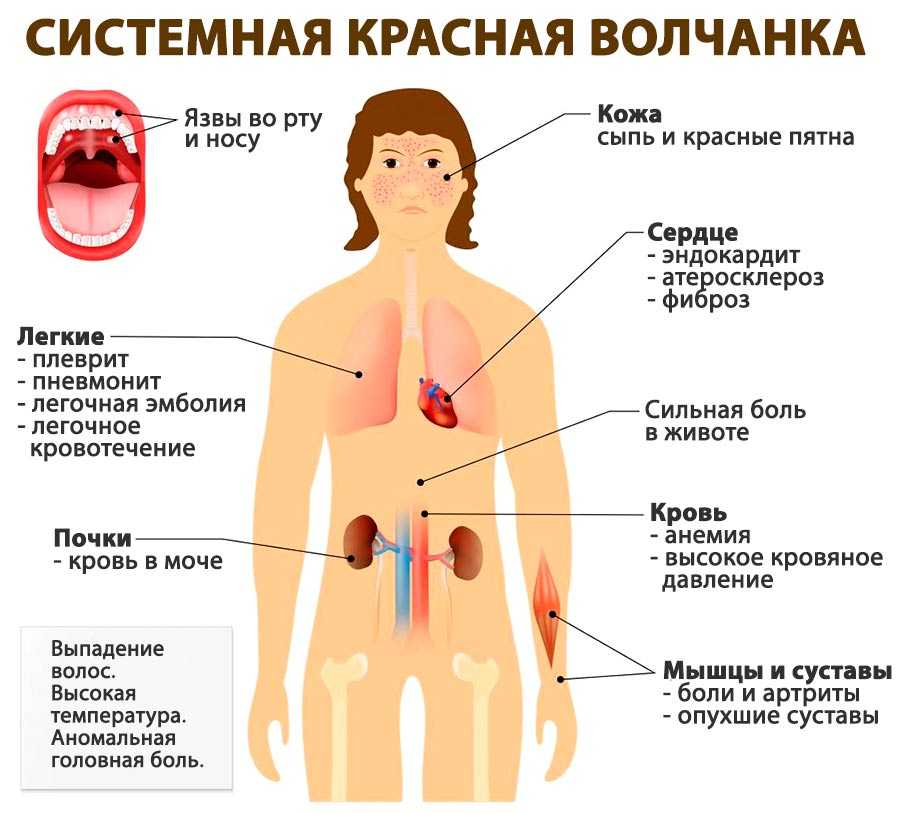 Красная волчанка симптомы анализ крови показатели лечение фото у женщин