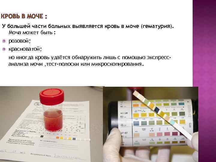 Кровь в моче – гематурия. диагностика, возможные причины