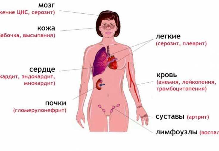 Системная красная волчанка: причины, диагностика, лечение