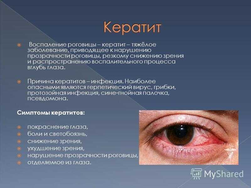 Кератит - причины, симптомы, лечение