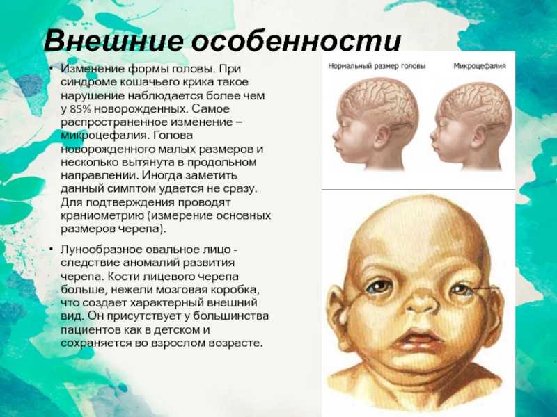 Синдром дауна у плода