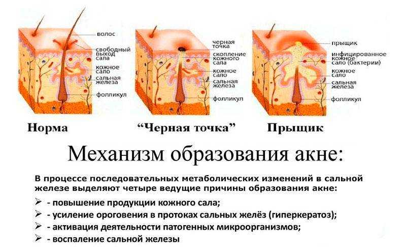 Прыщи на ягодицах: диагностика, лечение, профилактика