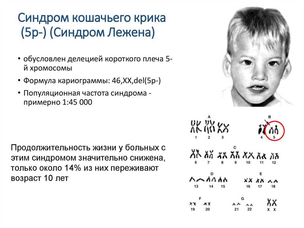 Каким номером на рисунке обозначен тип мутации характерный для больных с синдромом кошачьего крика