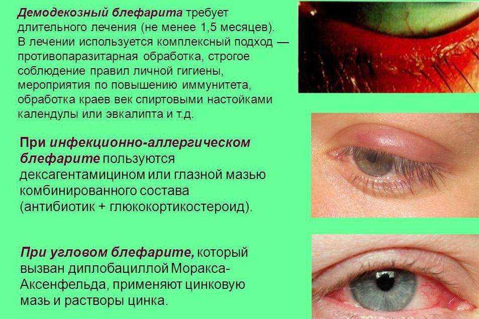 Конъюнктивит: симптомы с фото, схемы лечения