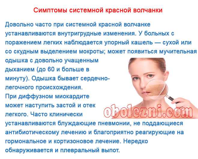 Системная красная волчанка - причины, симптомы, диагностика, лечение и профилактика