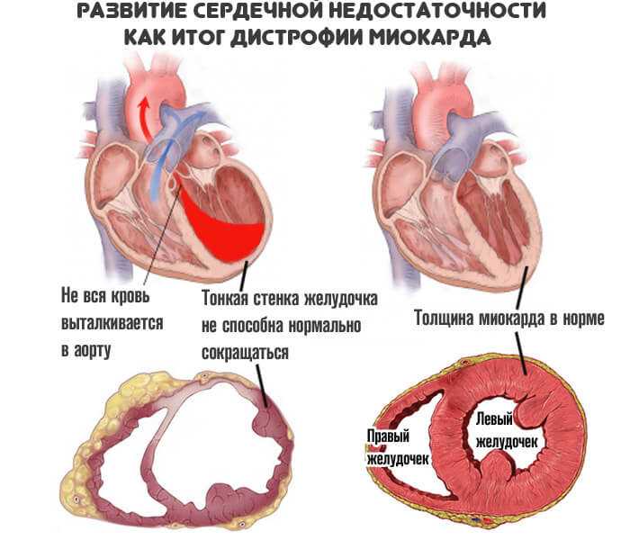 Миокардиальная сердечная недостаточность. Сердечная недостаточность. Дистрофические изменения сердца. Степени сердечной недостаточности.