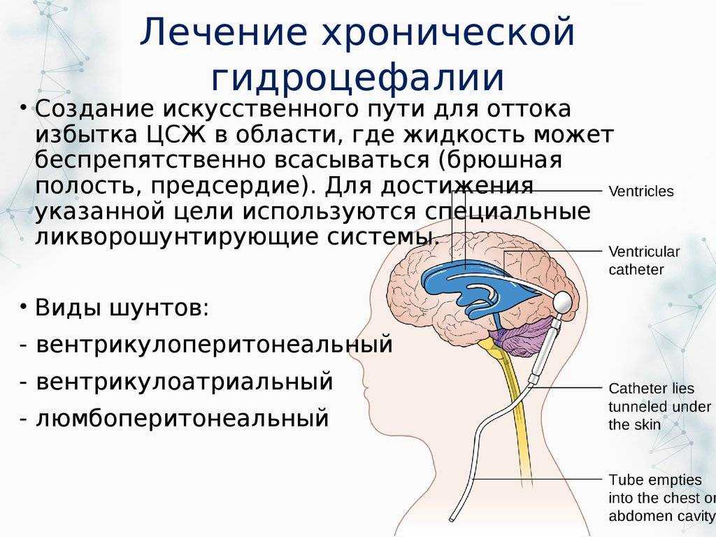 Картина внутренней гидроцефалии