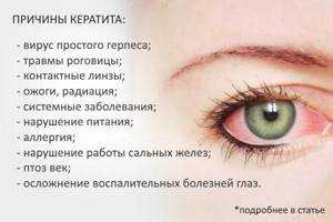 Герпетический кератит: причины, симптомы, лечение