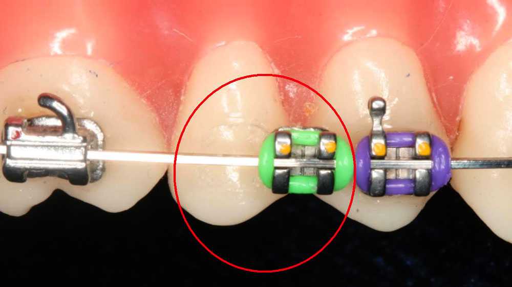 Отклеенный брекет. Отклеился замок на брекетах.