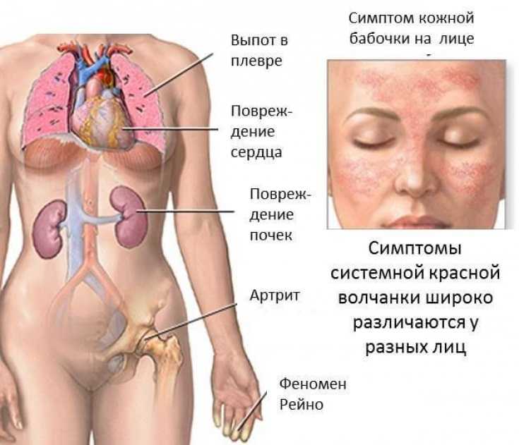 Красная волчанка симптомы анализ крови показатели лечение фото у женщин