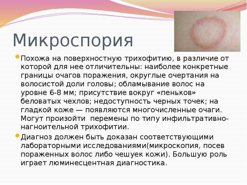 Виды кожных грибковых заболеваний таблица с картинками