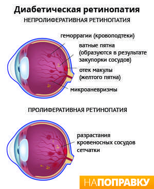 Лечение диабетической ретинопатии. Диабетическая ретинопатия глаз. Непролиферативная диабетическая ретинопатия патогенез. Диабетическая ретинопатия классификация клиника. Ретинопатия диабетическая капли в глаза.