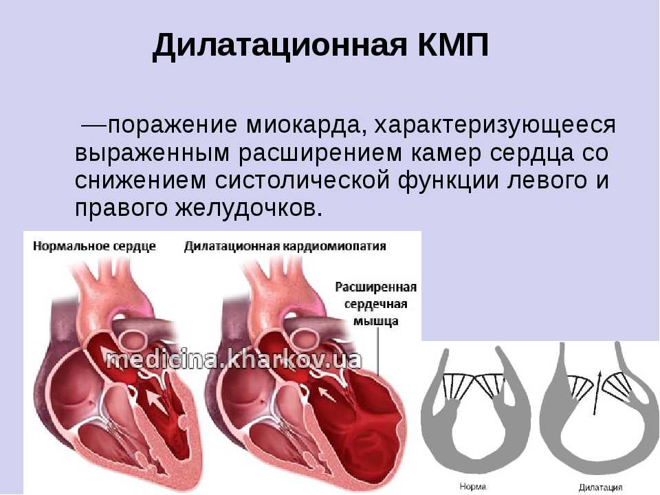 Миокард правого желудочка сердца. Кардиопатия дилатационная. Кардиопатия желудочка. Дилатационная кардиомиопатия сердца.