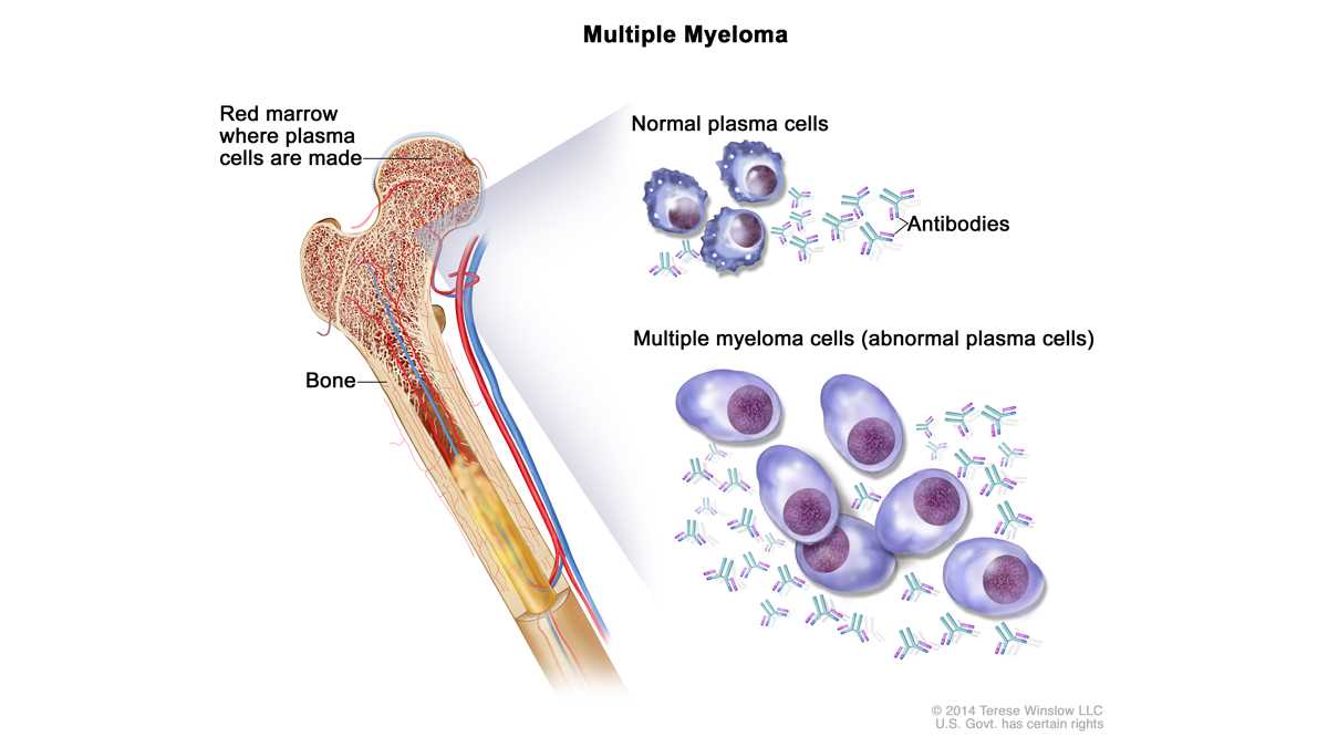Миелома это. Клинические проявления миеломной болезни. Костный мозг при множественной миеломе. Миеломная болезнь костный мозг.