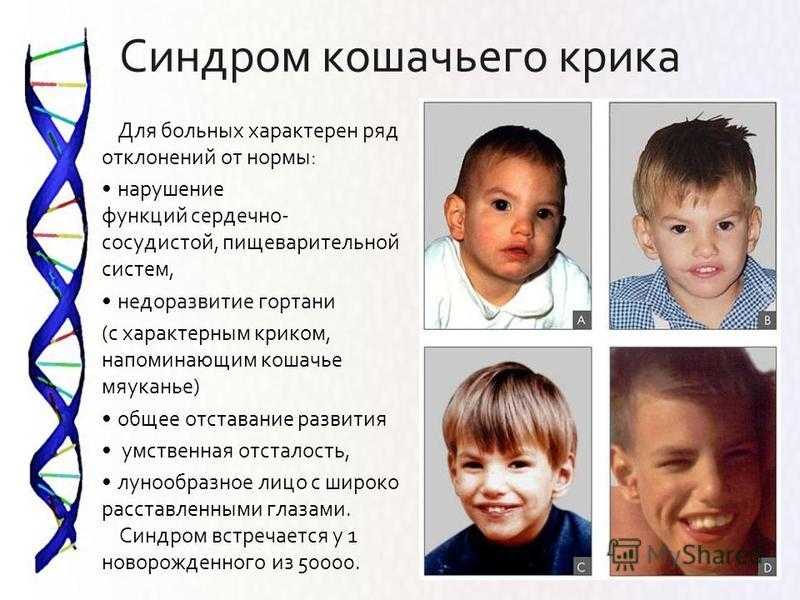 Синдром дауна: мифы и факты
