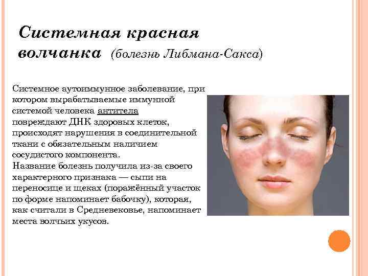 Что такое системная красная волчанка? причины, симптомы, лечение