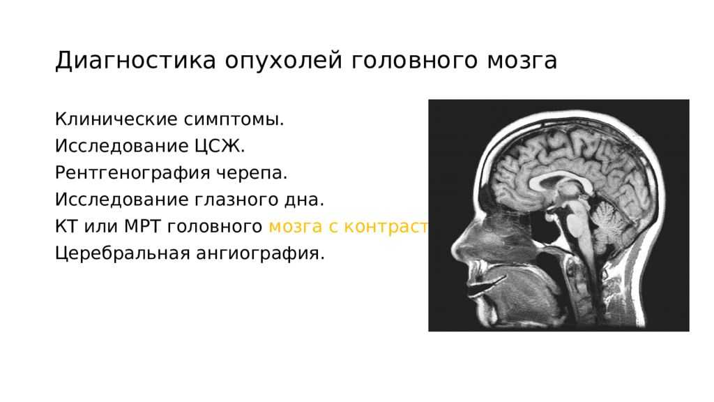 Диагноз опухоли головного. Понятие злокачественности опухоли головного мозга. Методы обследования при опухоли головного мозга. Диагностические критерии глиомы головного мозга. Клинические симптомы опухоли головного мозга.