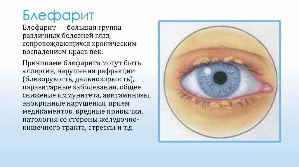 5 заболеваний глаз. Блефарит конъюнктивит. Заболевание глаз блефарит. Глазная болезнь блефарит. Блефарит конъюнктивит ячмень.