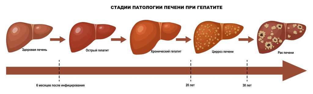Гепатит b, цирроз печени, гепатоцеллюлярная карцинома (гцк) – причины, симптомы * клиника диана в санкт-петербурге
