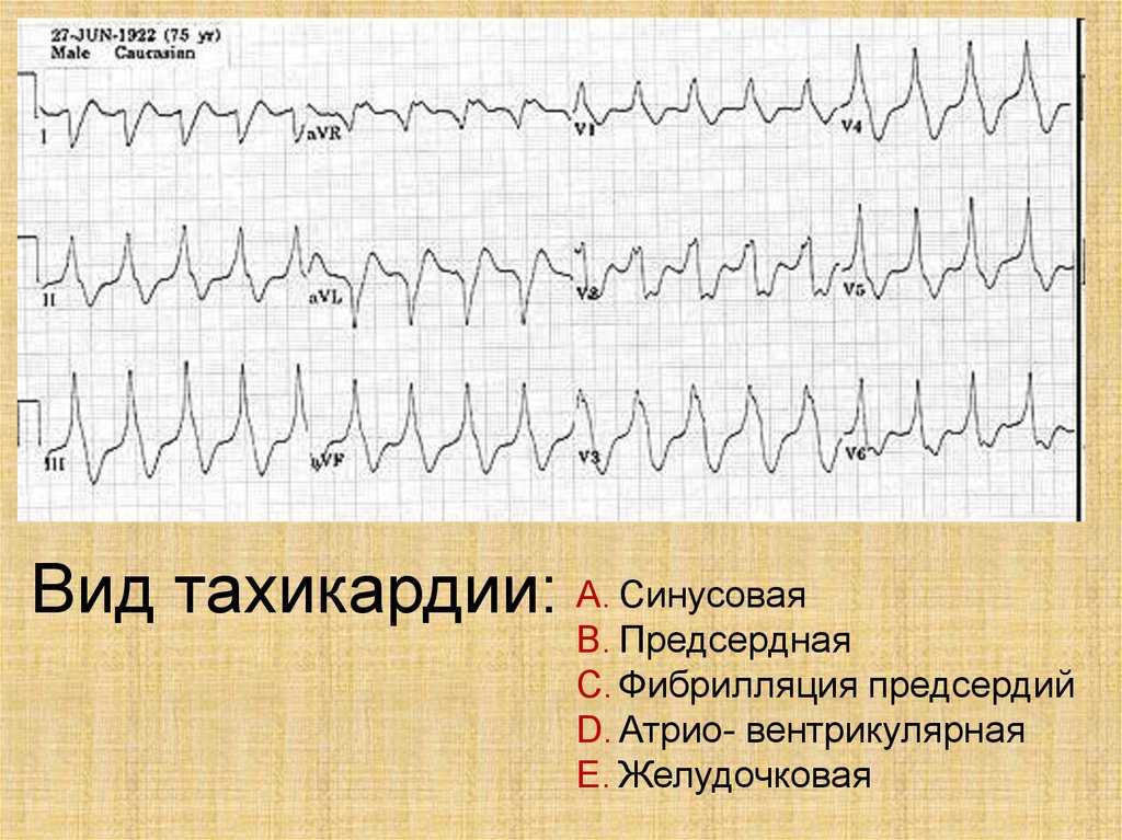 Тахикардия сердца симптомы