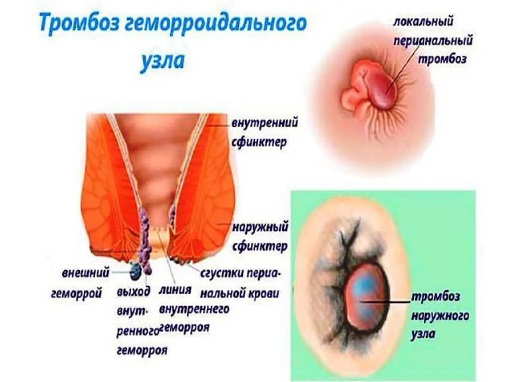 Осложнения геморроя клиническая картина