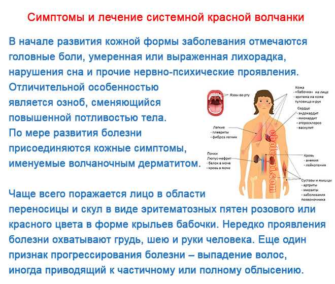 Системная красная волчанка (скв): диагностика, симптомы, лечение, анализы