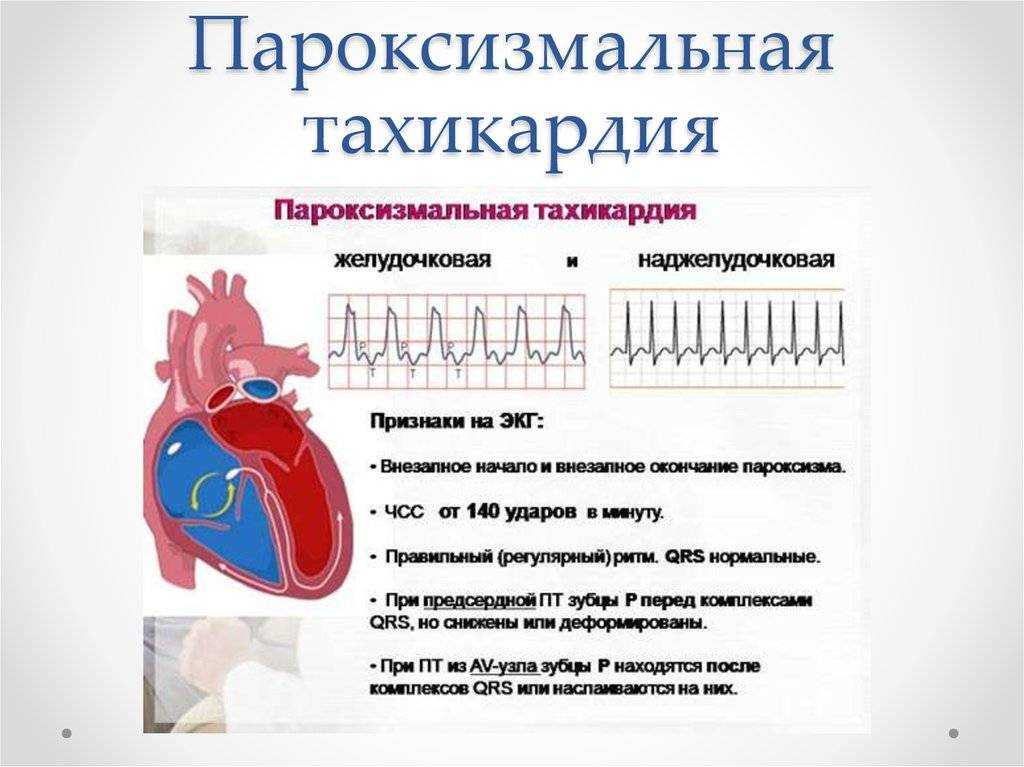 Тахикардия