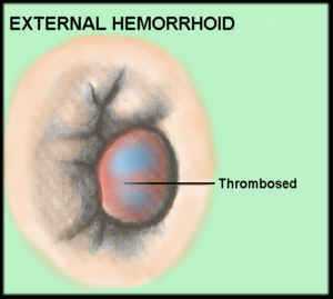 Стадии наружного геморроя схема