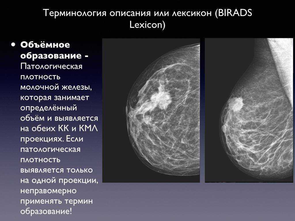 Эхографическое изображение злокачественной опухоли чаще представляет собой образование