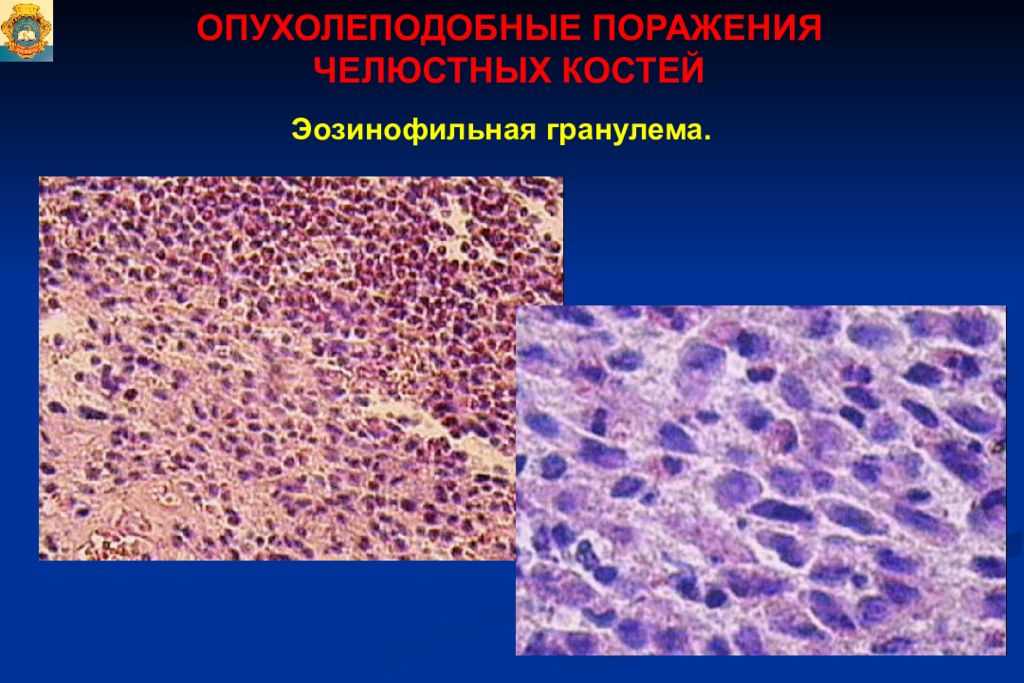 Болезнь кошачьих царапин (фелиноз, доброкачественный лимфоретикулёз). причины, симптомы, лечение и профилактика