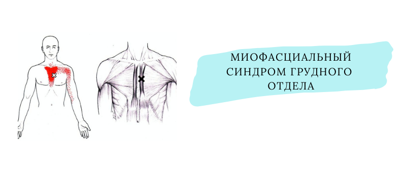 Миозит грудной мышцы. Миофасциальный болевой синдром спины. Миофасциальные синдромы грудного болевые грудной клетки. Миофасциальный синдром грудного отдела мышцы. Миофасциальный болевой синдром грудного отдела позвоночника.