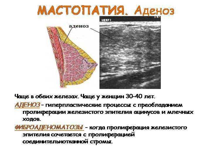 Узловая мастопатия молочной железы симптомы и признаки фото на узи