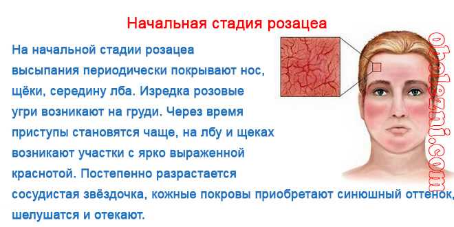 Розацеа лечение. Розацеа папуло пустулезная сыпь. Розацеа (папуло-пустулезная форма) у взрослых пациентов.. Розацеа начальный этап.