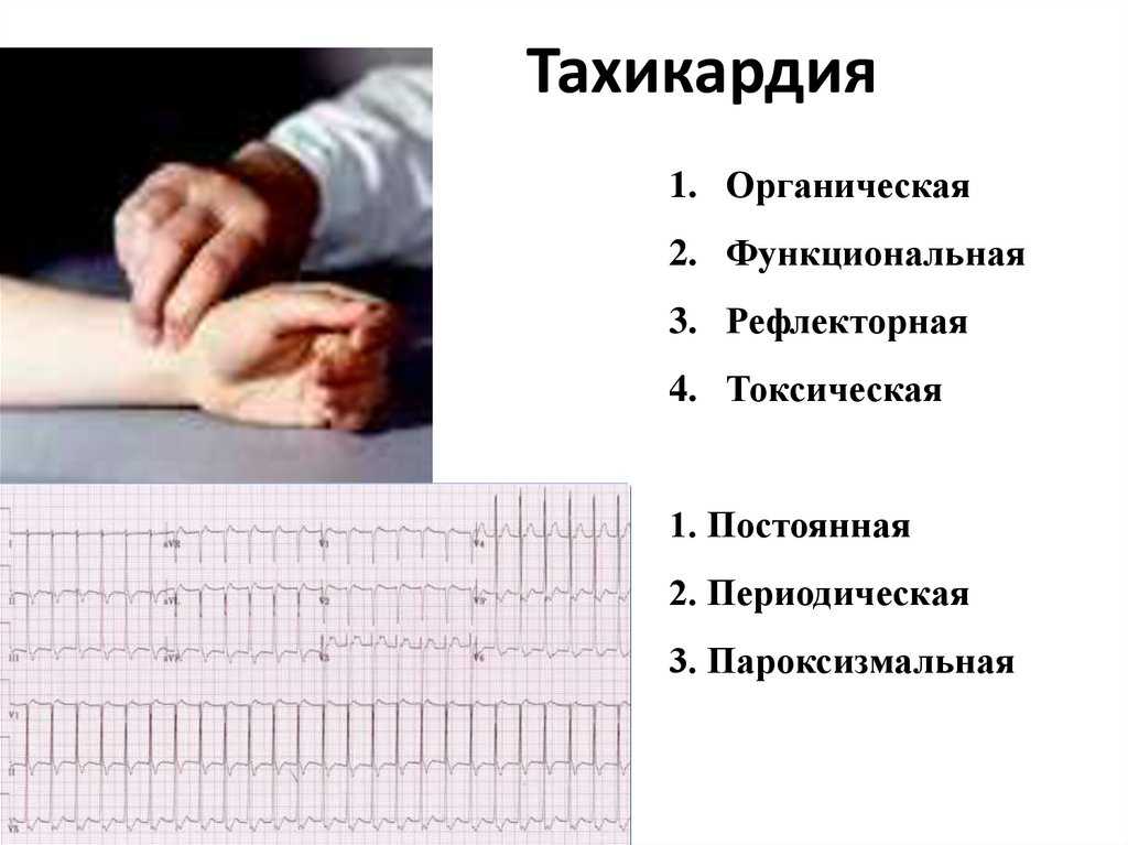 Редкий пульс: тахикардия и брадикардия, причины, симптомы – эл клиника