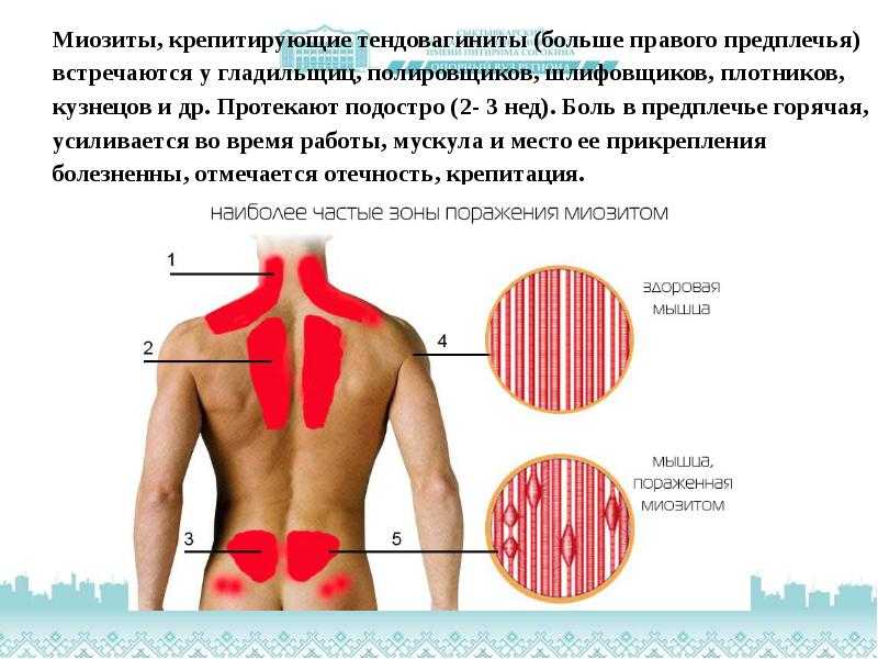 Включи боле. Воспаление мышц миозит. Воспаление скелетных мышц – миозит;. Проявление миозита мышцы.