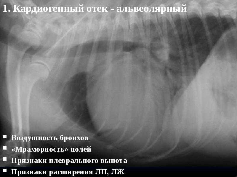 Жидкость в легких при онкологии: причины появления, симптомы, откачка жидкости из легких при раке | клиники «евроонко»