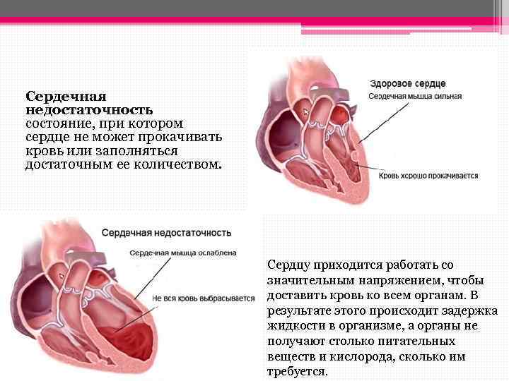 Изменения в кардиограмме при ишемической болезни сердца (ибс) и инфаркте миокарда | университетская клиника