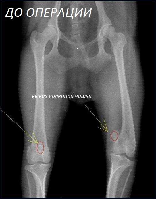 Вывих коленной чашечки. Медиальный вывих коленной чашечки у собак мелких пород. Вывих надколенника рентген. Медиальный вывих надколенника у собаки. Вывих коленной чашечки (надколенника) собаки.